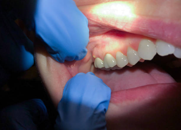 Best Dentist for Tooth Abscess  in Castle Dale, UT